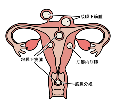 子宮筋腫